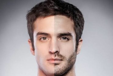 Beard / Moustache Transplant