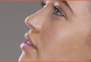 Rhinoplasty