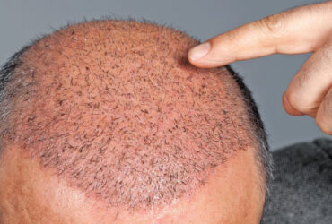 FUE Hair Transplantation