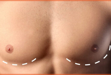 Liposuction